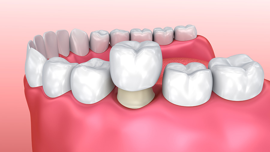 Dental Crowns Dentist Near Me