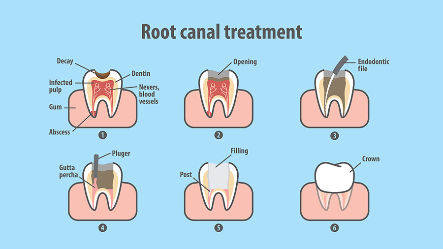 Root Canals Near Me