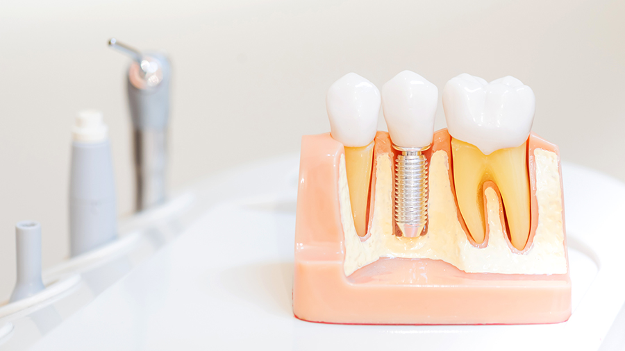 Dental implant dentists serving Greater Detroit MI