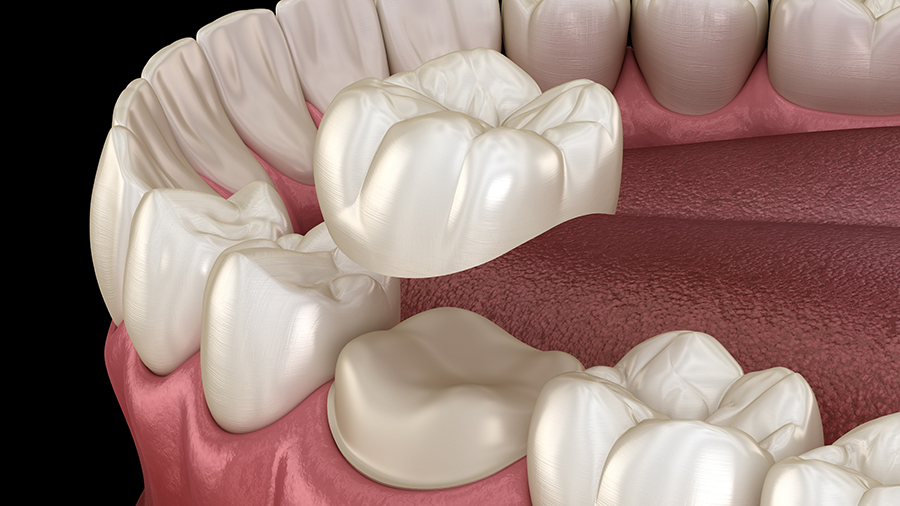 Dental crowns Southgate MI dentists